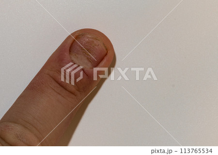 fungal nail infection Onychomycosis. dry coarse skin of the legs fungal nail infection Onychomycosis. dry coarse skin of the legs 113765534