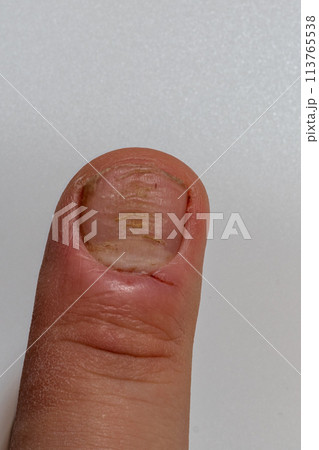 fungal nail infection Onychomycosis. dry coarse skin of the legs fungal nail infection Onychomycosis. dry coarse skin of the legs 113765538