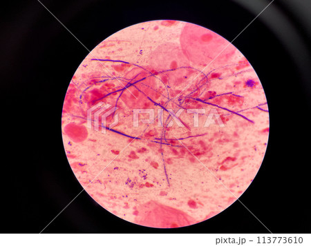 Mold yeast cell in sputum gram stain. 113773610