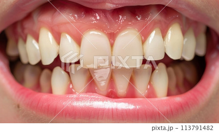 Close-up of human mouth with one crooked tooth, highlighting dental imperfections and oral health issues 113791482