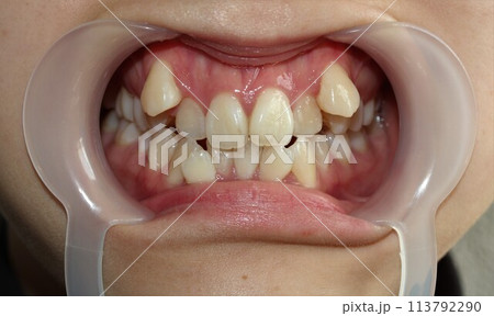 歯並びを気にする女性 歯並びを気にする女性 113792290