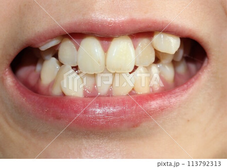 歯並びを気にする女性 113792313