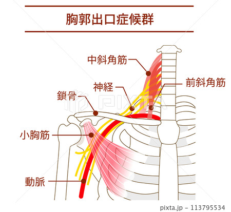 胸郭出口症候群の仕組みと原因 胸郭出口症候群の仕組みと原因 113795534