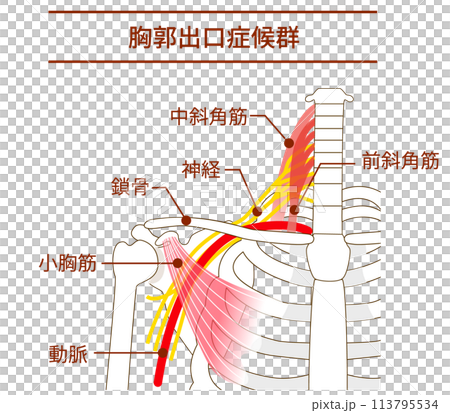 胸郭出口症候群の仕組みと原因 胸郭出口症候群の仕組みと原因 113795534