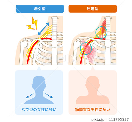 胸郭出口症候群2つの種類、牽引型と圧迫型 胸郭出口症候群2つの種類、牽引型と圧迫型 113795537