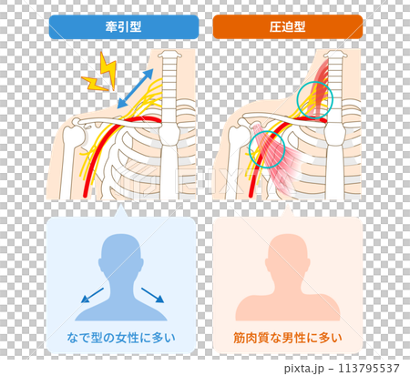 胸郭出口症候群2つの種類、牽引型と圧迫型 胸郭出口症候群2つの種類、牽引型と圧迫型 113795537