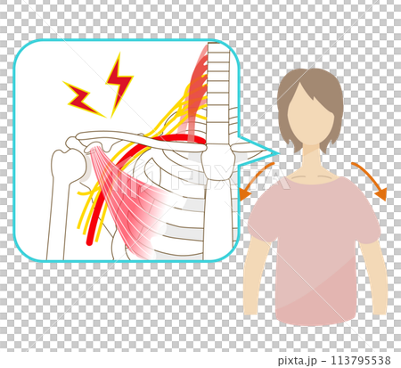 胸郭出口症候群の痛みに苦しむ、なで肩の女性 胸郭出口症候群の痛みに苦しむ、なで肩の女性 113795538