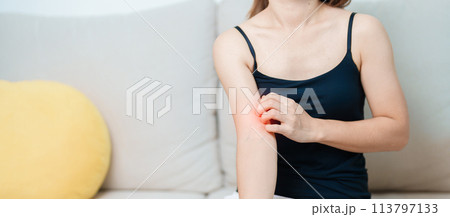 woman itching and scratching itchy arm. Sensitive Skin Allergic reaction to insect bite, food, drug dermatitis. Dermatology, Leprosy day, Systemic lupus erythematosus, Allergy symptoms and rash Eczema woman itching and scratching itchy arm. Sensitive Skin Allergic reaction to insect bite, food, drug dermatitis. Dermatology, Leprosy day, Systemic lupus erythematosus, Allergy symptoms and rash Eczema 113797133