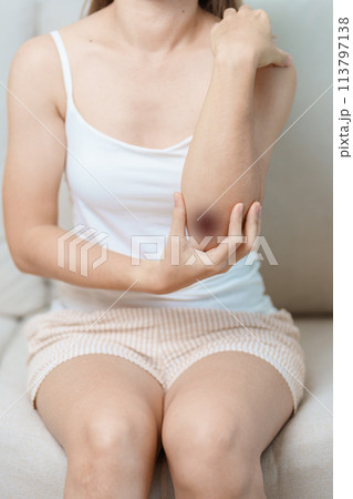 Bruise, wound and Contusion concepts. Woman having bruised on Elbow and Arm due to accident. Skin Injury, body pain and ache 113797138