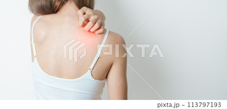 woman itching and scratching itchy back. Sensitive Skin Allergic reaction to insect bite, food, drug dermatitis. Dermatology, Leprosy, Systemic lupus erythematosus, Allergy symptoms and rash Eczema 113797193