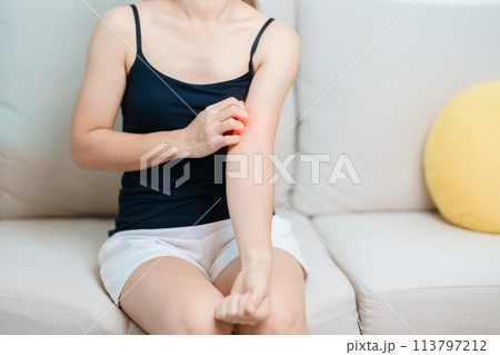 woman itching and scratching itchy arm. Sensitive Skin Allergic reaction to insect bite, food, drug dermatitis. Dermatology, Leprosy day, Systemic lupus erythematosus, Allergy symptoms and rash Eczema woman itching and scratching itchy arm. Sensitive Skin Allergic reaction to insect bite, food, drug dermatitis. Dermatology, Leprosy day, Systemic lupus erythematosus, Allergy symptoms and rash Eczema 113797212
