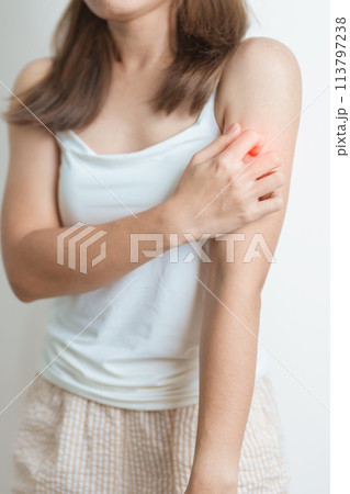 woman itching and scratching itchy arm. Sensitive Skin Allergic reaction to insect bite, food, drug dermatitis. Dermatology, Leprosy day, Systemic lupus erythematosus, Allergy symptoms and rash Eczema 113797238