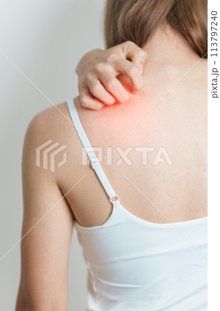 woman itching and scratching itchy back. Sensitive Skin Allergic reaction to insect bite, food, drug dermatitis. Dermatology, Leprosy, Systemic lupus erythematosus, Allergy symptoms and rash Eczema woman itching and scratching itchy back. Sensitive Skin Allergic reaction to insect bite, food, drug dermatitis. Dermatology, Leprosy, Systemic lupus erythematosus, Allergy symptoms and rash Eczema 113797240