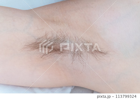 Closeup of long dark hair growing under arm of young female. Concept of hygiene, natural beauty, feminity and body hair growth 113799324