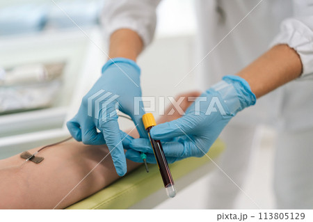 Unrecognizable female lab assistant in blue medical gloves taking venous blood from arm of woman patient for examination or PRP procedure. Concept of laboratory research, medicine, analysis 113805129