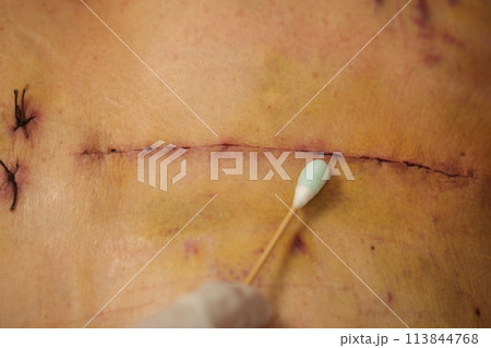doctor using alcohol and cotton bud cleaning wound from open heart surgery on female body (Heart Valve Regurgitation) doctor using alcohol and cotton bud cleaning wound from open heart surgery on female body (Heart Valve Regurgitation) 113844768