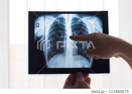 Lung radiography concept. Radiology doctor examining at chest x ray film of patient Lung Cancer or Pneumonia. Virus and bacteria infected the Human lungs. Patient with Lung Cancer or Pneumonia Lung radiography concept. Radiology doctor examining at chest x ray film of patient Lung Cancer or Pneumonia. Virus and bacteria infected the Human lungs. Patient with Lung Cancer or Pneumonia 113860674