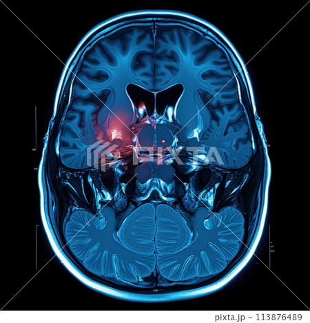 CT scan of human brain digital image 113876489