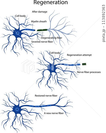 An attempt at nerve fiber regeneration. Damage and degeneration of the nerve fiber. An attempt at nerve fiber regeneration. Damage and degeneration of the nerve fiber. 113892363