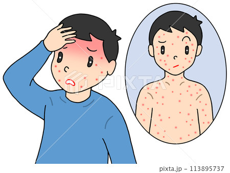 病気・疾病・疾患 - 大人のはしか・麻疹・発疹・発熱 113895737