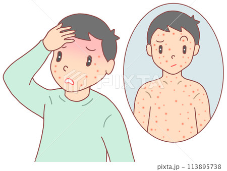 病気・疾病・疾患 - 大人のはしか・麻疹・発疹・発熱 病気・疾病・疾患 - 大人のはしか・麻疹・発疹・発熱 113895738