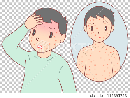 病気・疾病・疾患 - 大人のはしか・麻疹・発疹・発熱 病気・疾病・疾患 - 大人のはしか・麻疹・発疹・発熱 113895738