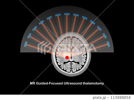 MR-guided focused ultrasound thalamotomy for the treatment of tremor. 113899858
