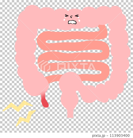 Illustration of acute appendicitis 113903400