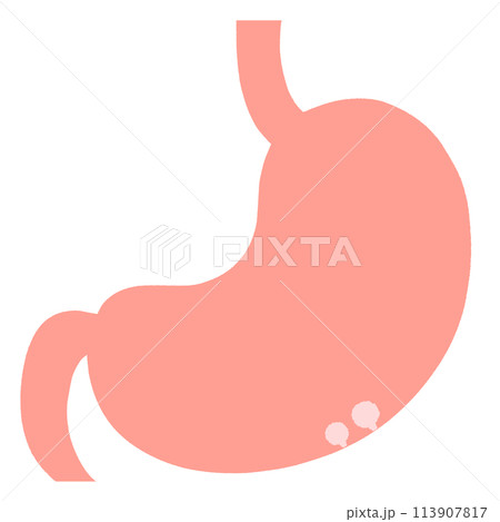 自覚症状のない良性のポリープがある胃のイラスト 自覚症状のない良性のポリープがある胃のイラスト 113907817