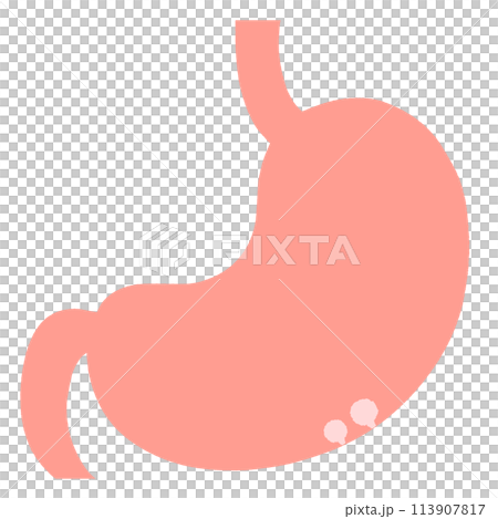 自覚症状のない良性のポリープがある胃のイラスト 自覚症状のない良性のポリープがある胃のイラスト 113907817