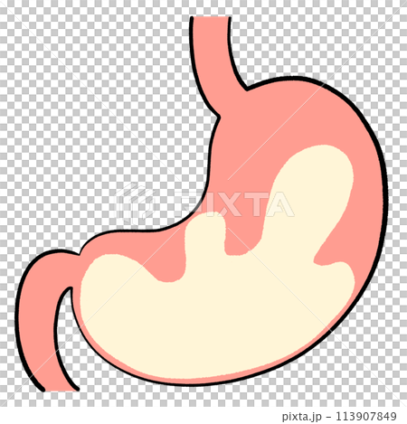 Illustration of hyperacidity Illustration of hyperacidity 113907849