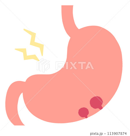 慢性胃炎とポリープのある胃のイラスト 113907874