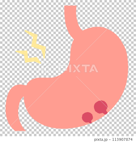 慢性胃炎とポリープのある胃のイラスト 113907874