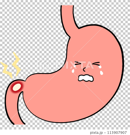 Illustration of duodenal ulcer 113907907