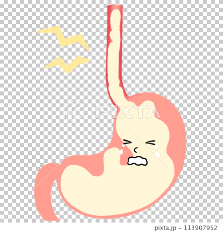 逆流性食道炎のイラスト 逆流性食道炎のイラスト 113907952