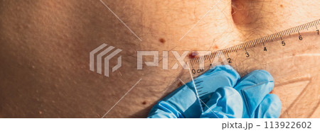 Unrecognizable Doctor in medical gloves examining length and width of benign moles on man skin. Dermatologist checking male birthmarks with ruler Unrecognizable Doctor in medical gloves examining length and width of benign moles on man skin. Dermatologist checking male birthmarks with ruler 113922602