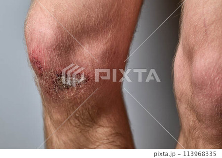 the wound on the knee was treated with hydrogen peroxide the wound on the knee was treated with hydrogen peroxide 113968335
