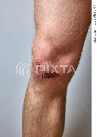 scratch, knee wound on a man's knee 113968347