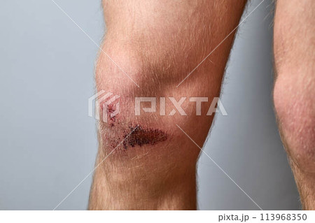scratch, knee wound on a man's knee scratch, knee wound on a man's knee 113968350