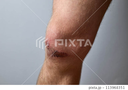scratch, knee wound on a man's knee scratch, knee wound on a man's knee 113968351