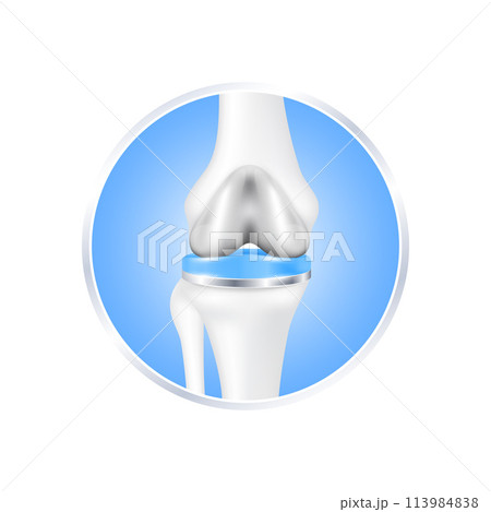 label aluminum. Knee replacement surgery total implant for treatment relieve arthritis, after joint damaged. Leg bone cartilage. Isolated on white background for product design. Realistic 3d vector. 113984838