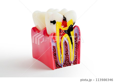 Decay tooth replace with dental implant root canal teeth model for education isolated on white background with clipping path. Decay tooth replace with dental implant root canal teeth model for education isolated on white background with clipping path. 113986346