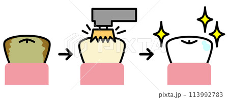 汚れた歯をブラシで掃除して綺麗にホワイトニングされた歯のイラスト 汚れた歯をブラシで掃除して綺麗にホワイトニングされた歯のイラスト 113992783