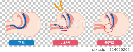 打鼾和睡眠呼吸中止症 114020202