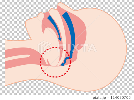 Mechanism of sleep apnea syndrome 114020706