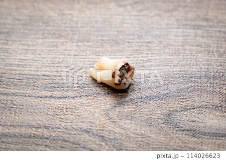 虫歯になった人の永久歯の写真。抜歯された親知らずの虫歯の写真。 虫歯になった人の永久歯の写真。抜歯された親知らずの虫歯の写真。 114026623