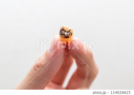 虫歯になった人の永久歯の写真。抜歯された親知らずの虫歯の写真。 虫歯になった人の永久歯の写真。抜歯された親知らずの虫歯の写真。 114026625