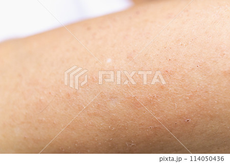 湿疹　皮膚病　腕　かぶれ　あせも　　 114050436