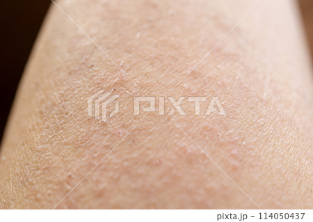 湿疹 皮膚病 かぶれ あせも 腕 湿疹 皮膚病 かぶれ あせも 腕 114050437