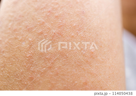 かぶれ　あせも　皮膚病　湿疹　　腕 114050438